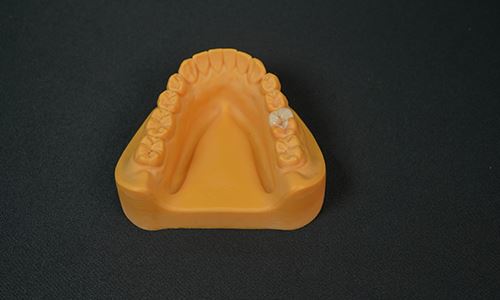 IPS Emax Inlay