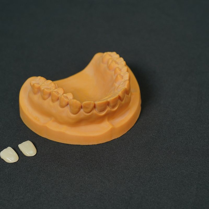 IPS Emax Veneer